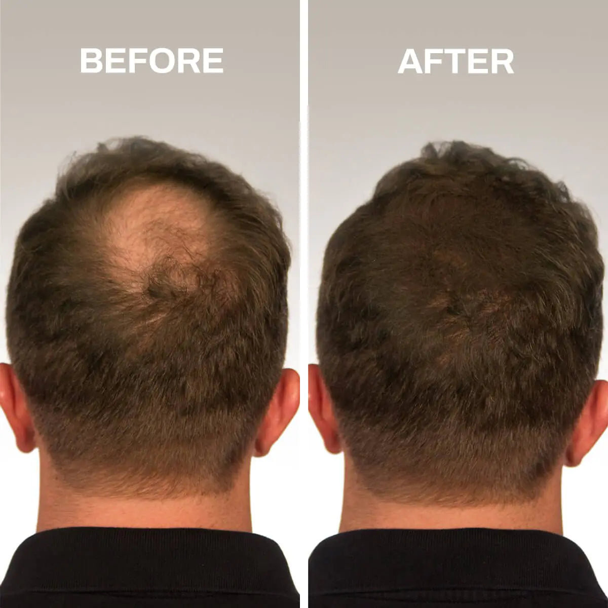 Hair Fibers Thinning Hair